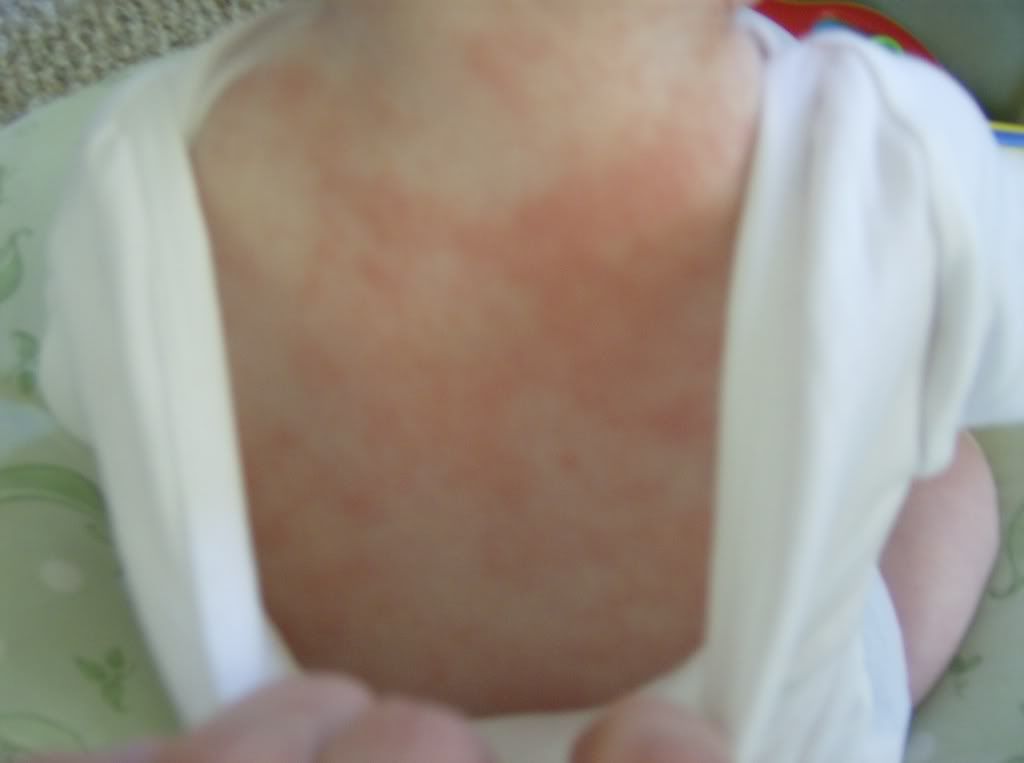 rash from laundry detergent rash from laundry detergent
